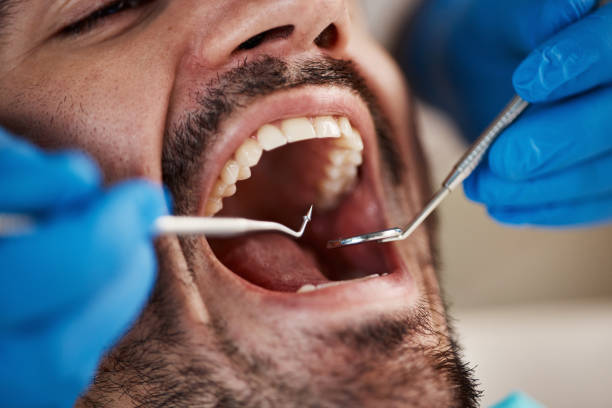 Best Knocked-Out Tooth (Avulsed Tooth) Treatment in Sitka, AK